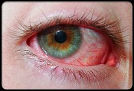 Causes of Red Eye - Symptoms, Reasons and Why You Have Red Eyes