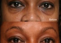 How to Cure Dark under Eye Circles – Facials and Peels to Cure Dark under Eye Circles