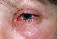 Viral Pink Eye – Causes, Symptoms, Cures, Treatments, Prevention Diagnosis of Viral Conjunctivitis