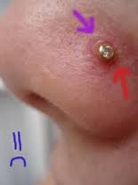 Nose Piercing Infection Pictures - 2