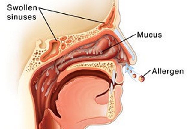 Swollen Nasal Passages - Causes Allergies Treatment