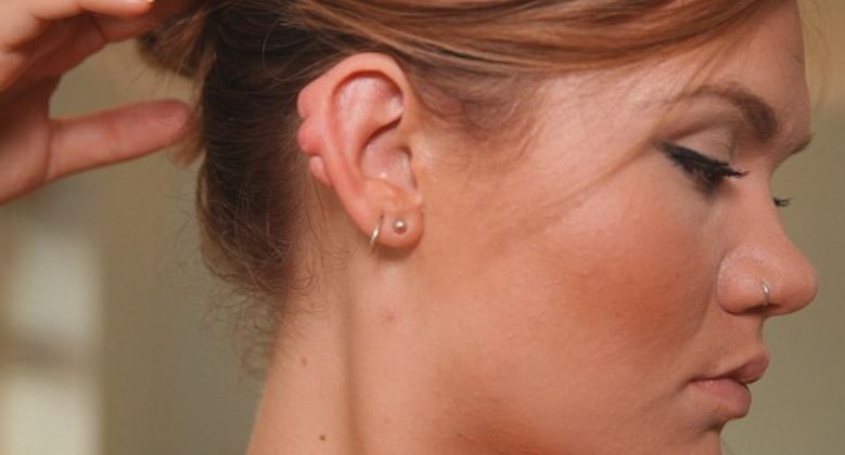 Keloids from ear piercings